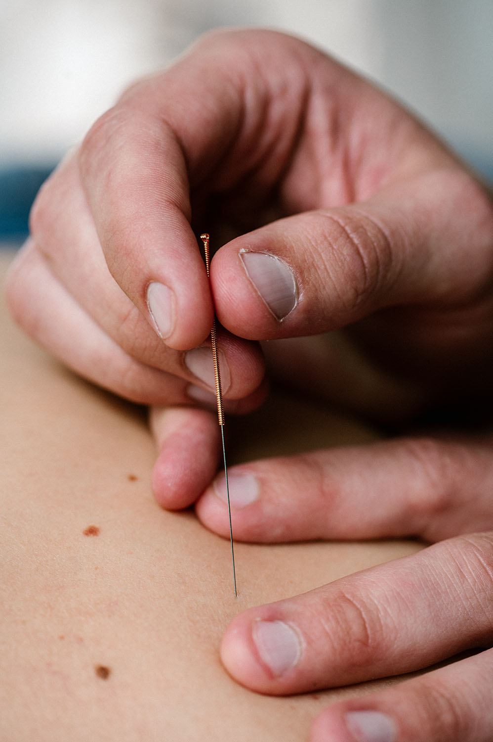 Dry needling