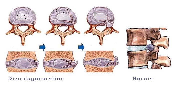 disc-degeneration